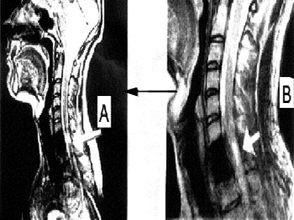 МРТ - изображение пациента З до лечения (А), через 4 месяца (B)