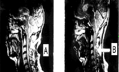 МРТ изображение пациента К до лечения (А), через 44 дня (B)